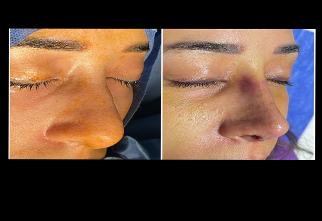 تجميل ورسم الأنف بعملية تجميل الأنف